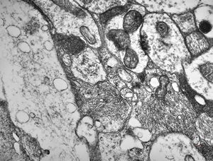 M,13y. | ganglioglioma M,13y. | ganglioglioma